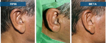 Όλο το υλικό το οποίο αφαιρείται κατά την εκτομή της ελιάς, πρέπει να αποστέλλεται απαραιτήτως για ιστολογική εξέταση, ώστε αφενός μεν να τίθεται η επακριβής ιστολογική διάγνωση, αφετέρου δε να επιβεβαιώνεται η εκτομή της βλάβης σε υγιείς ιστούς.