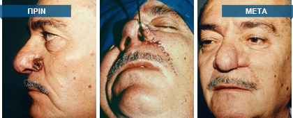 Ευρεία εκτομή της βλάβης μακροσκοπικά σε υγιείς ιστούς και άμεση επιτόπου πλαστική αποκατάσταση του ελλείμματος.