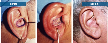 Η χειρουργική αφαίρεση πάσης φύσεως δερματικών βλαβών από το πρόσωπο, καθώς και η πλαστική αποκατάσταση των ελλειμμάτων που δημιουργούνται, είναι η προτιμότερη μέθοδος σε σύγκριση με κάθε άλλου είδους τεχνικές αφαίρεσης βλαβών.