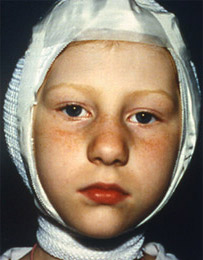 Mετά την εγχείρηση τοποθετούνται γύρω από τα δύο αυτιά ειδικές γάζες, εμποτισμένες αντιβιοτική αλοιφή για αποφυγή μόλυνσης, ελαστικός επίδεσμος και προστατευτικό δίχτυ για 5 - 6 ημέρες.