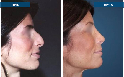 Ταυτόχρονη πλαστική  εγχείρηση μύτης και ρινικού διαφράγματος. ΠΡΙΝ, 2007 - 8 χρόνια ΜΕΤΑ, 2015