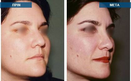 Ταυτόχρονη πλαστική  εγχείρηση μύτης και ρινικού διαφράγματος. ΠΡΙΝ, 1993 - 11 χρόνια ΜΕΤΑ, 2004