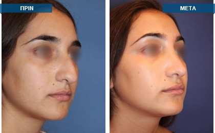 Ανοιχτή ρινοπλαστική με διόρθωση του ρινικού διαφράγματος και κογχοτομή. Ταυτόχρονη αφαίρεση ύβου με στένεμα και ανόρθωση της κορυφής της μύτης.