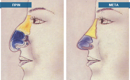 Ο εξειδικευμένος χειρουργός στη ρινοπλαστική επεμβαίνει όχι μόνο στα μαλακά μόρια της μύτης, δηλαδή δέρμα, συνδετικό ιστό και μύες, αλλά κατά κύριο λόγο στα οστέινα και χόνδρινα μέρη της, τα οποία αποτελούν το σκελετό της ρινικής πυραμίδας (τρισδιάστατο όργανο)