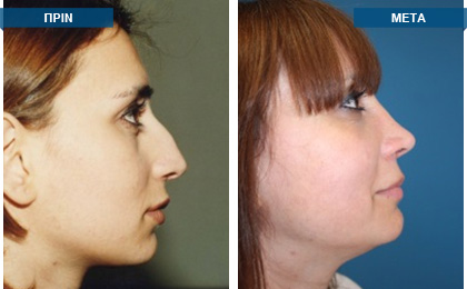 Eγχείρηση ρινικού διαφράγματος και ρινοπλαστική το 1998 - Mετεγχειρητικό αποτέλεσμα 17 χρόνια μετά