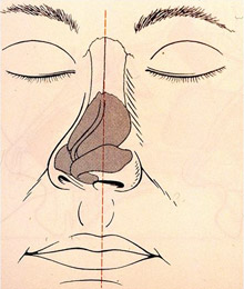 To σκολιωτικό ρινικό διάφραγμα