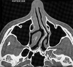 Αξονική τομογραφία: Εμφανής η σκολίωση του ρινικού διαφράγματος.