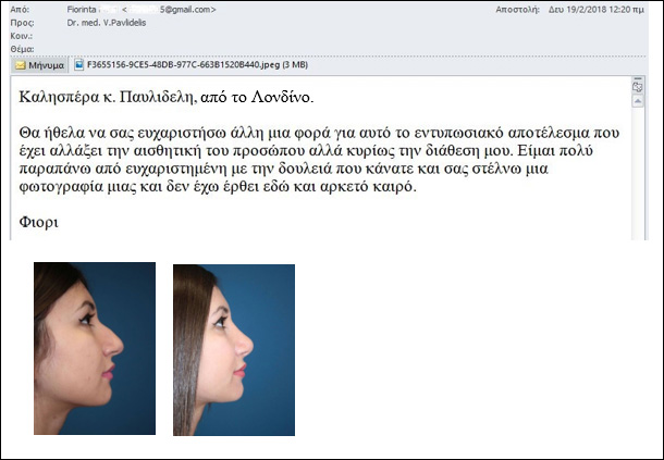 Εμπειρίες για ρινοπλαστική της κ. Φ... Π..., που προσήλθε από Λονδίνο, Φεβρουάριος 2018