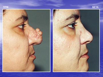 Διαφάνεια από την ομιλία του Dr. med. B. Παυλιδέλη.