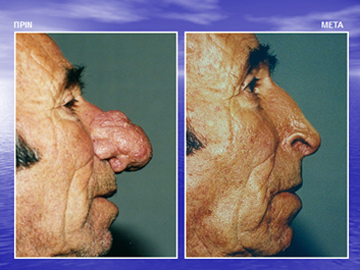 Διαφάνεια από την ομιλία του Dr. med. B. Παυλιδέλη.