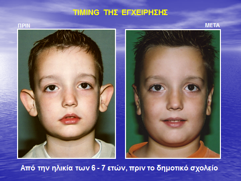 Διόρθωση πεταχτών αυτιών σε ηλικία 6 ετών.