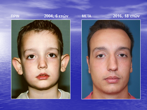 Το ίδιο περιστατικό, 16 χρόνια μετά τη διόρθωση πεταχτών αυτιών, σε ηλικία 18 ετών.