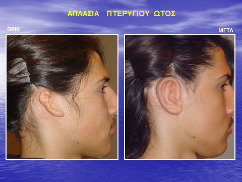 Αποκατάσταση ελλείποντος πτερυγίου αυτιού σε εκ γενετής μικρωτία - ανωτία - απλασία ωτός με αυτογενή πλευρικό χόνδρο.