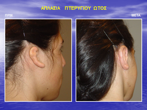 Αποκατάσταση ελλείποντος πτερυγίου αυτιού σε εκ γενετής μικρωτία - ανωτία - απλασία ωτός με με αυτογενή πλευρικό χόνδρο.