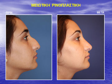 Ταυτόχρονη πλαστική εγχείρηση μύτης και ρινικού διαφράγματος