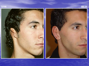 Περιστατικό ανάπλασης ελλείποντος πτερυγίου αυτιού,
ΠΡΙΝ - ΜΕΤΑ