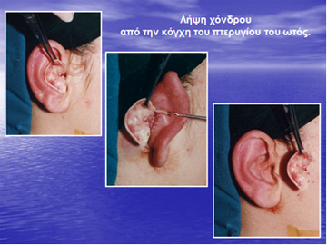 Λήψη χόνδρινου μοσχεύματος από το πτερύγιο του αυτιού του ίδιου του ασθενούς, για τη διόρθωση αποτυχημένης ρινοπλαστικής.