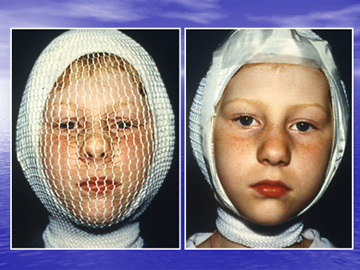 Τοποθέτηση ελαστικού επιδέσμου και προστατευτικό δίχτυ για 4 ημέρες, μετά από εγχείρηση ωτοπλαστικής.