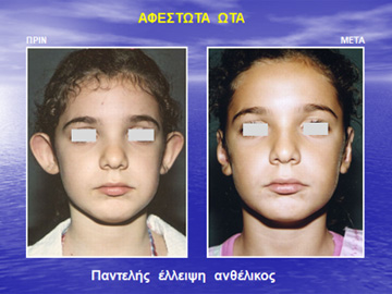 Η ωτοπλαστική συστήνεται να πραγματοποιείται σε ηλικία 6 ετών, πριν πάει το παιδί στο σχολείο.