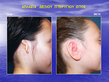Η κατάλληλη ηλικία για την ανάπλαση πτερυγίου ωτός είναι από 8 ετών και μετά.