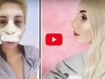 Video: Ρινοπλαστική: Η Φαίη - GirlsNextDoor περιγράφει βήμα βήμα την εμπειρία της από την πλαστική στη μύτη της.