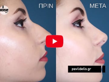 Video: Η Ρινοπλαστική σήμερα. Ρεπορτάζ στο ιατρείο του ρινπλαστικού Β. Παυλιδέλη.